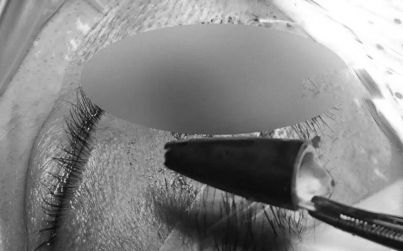 Người đàn ông đau mắt dữ dội, bác sĩ lấy ra thứ "đáng sợ"