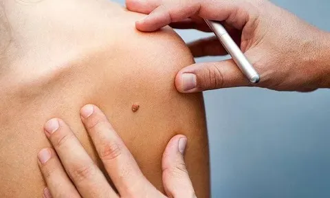 Căn bệnh ung thư có nguyên nhân từ môi trường và lối sống hằng ngày, dấu hiệu chỉ là một chấm 'bé như đầu tăm'