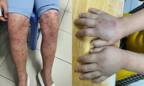 Cảnh báo biến chứng suy thận suốt đời từ viêm mạch máu ở trẻ