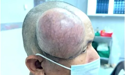 Phẫu thuật thành công khối u to như cái chén ở đầu bệnh nhân