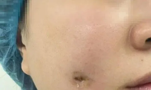 Người phụ nữ bị nhiễm trùng sau khi làm má lúm đồng tiền