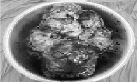 Cắt bỏ khối u dạ dày “khủng” nặng 3,7kg cho bệnh nhân nữ từng sợ …mổ