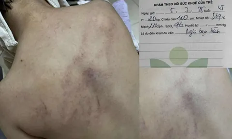 Vụ cháu bé 4 tuổi bị đánh, ném vào tường ở Hà Nội: Cô giáo bạo hành nói gì?